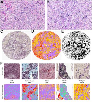 Dissecting and Reconstructing Matrix in Malignant Mesothelioma Through Histocell-Histochemistry Gradients for Clinical Applications